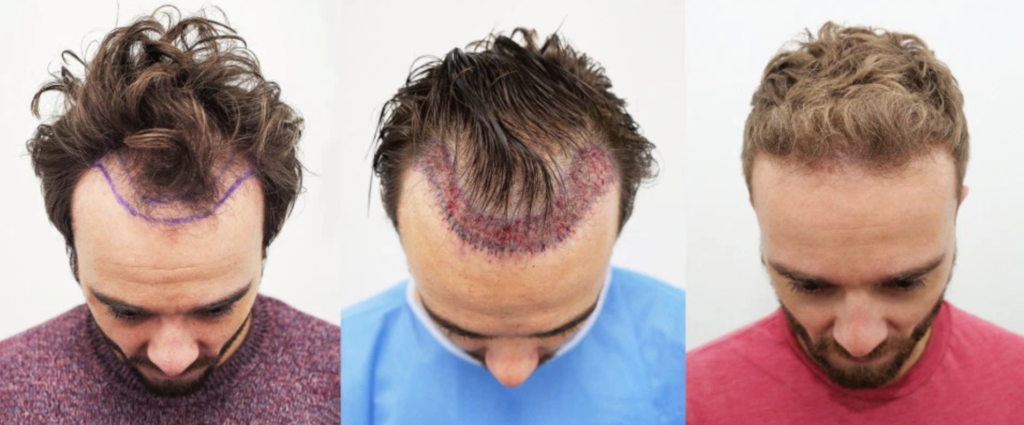 Why You Should Have a Hair Transplant in the USA